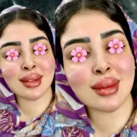 تزریق ژل فقط سیسی ۸۰۰بمدت سه روز|خدمات آرایشگری و زیبایی|زاهدان, |دیوار