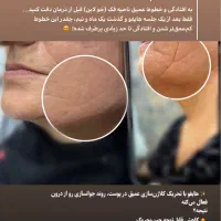 جوانسازی‌ولیفت‌صورت‌باهایفورفع‌تیرگی‌لک‌وتتوبالیزر