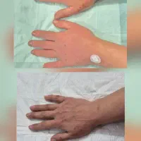 تزریق و ساکشن چربی