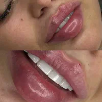 جشنواره یلدایی تخفیف ژل لب،بوتاکس توسط پزشک متخصص|خدمات آرایشگری و زیبایی|کرج, گلشهر|دیوار