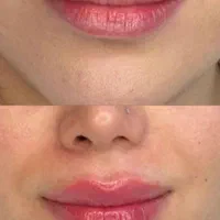 فیلر لب ، خط خنده، زاویه ، مزو فقط ۱۸۰۰|خدمات آرایشگری و زیبایی|محمدیه-قزوین, |دیوار