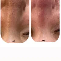 فیشیال و پاکسازی تخصصی پوست