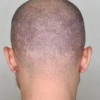 میکرواسکالپ|خدمات آرایشگری و زیبایی|تهران, قیطریه|دیوار