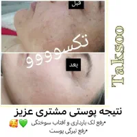 درمان لک صورت با محصولات گیاهی زیر نظر متخصص پوست