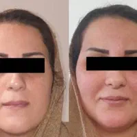 ساکشن(تخلیه) و تزریق بدن و صورت تخصصی در کلینیک|خدمات آرایشگری و زیبایی|اهواز, کیانپارس |دیوار