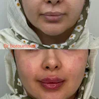 جشنواره ژل لب/فیلرلب/بوتاکس/آنزیم توسط پزشک