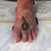 سمزدایی وحجامت