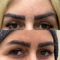 تزریق ژل بوتاکس فیلرجوانساز/اقساط بدون پیش پرداخت