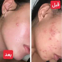 کرم و صابون ضد جوش و پاک کننده لک جوش