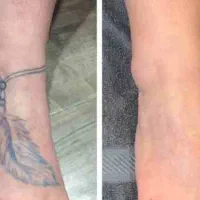 نیازمند مدل جهت پاک  کردن تتو