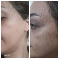 حذف لک و منافذ باز و جای جوش/زیر نظر متخصص پوست|خدمات آرایشگری و زیبایی|مشهد, الهیه|دیوار