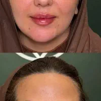 ژل لب و ژل گونه و زاویه سازی توسط پزشک