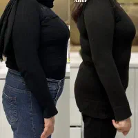 لاغری با بوتاکس معده در رشت