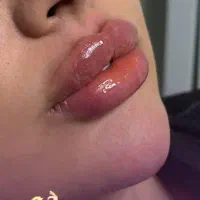 مطب پزشک.ژل وبوتاکس.لیفت بانخ.فیلربینی ژل آلت|خدمات آرایشگری و زیبایی|قم, دورشهر|دیوار