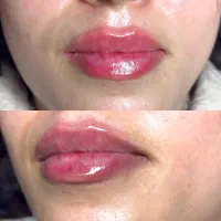 جشنواره ژل گونه، چانه، زاویه فک و لب