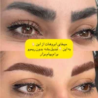 درمان تتوی قدیمی دریک جلسه