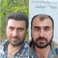 کاشت مو،ریش،ابرو