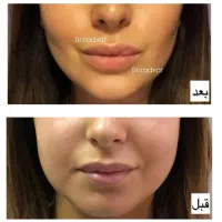 ساکشن غبغب،غبغب،بوکالفت،بوکال فت،لیپوفیس