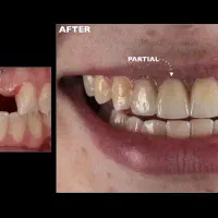جای خالی دندون‌هات رو با هزینه‌ای کمتر پر کن