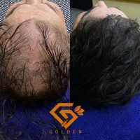 میکرواسکالپ/پرپشتی تضمینی مو/رفع طاسی