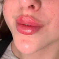 فیلر لب ژل گونه فک بوتاکس لیزرساکشن غبغب کاشت مو|خدمات آرایشگری و زیبایی|رشت, گلسار|دیوار