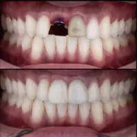 دندانپزشکی ایمپلنت تخصصی از ۵ میلیون اقساطی وام|خدمات آرایشگری و زیبایی|تبریز, |دیوار