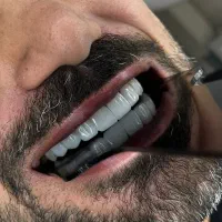 خدمات دندانپزشکی کامپوزیت لمینت عصب کشی|خدمات آرایشگری و زیبایی|تهران, تهرانپارس غربی|دیوار