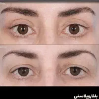کاشت ابرو/بلفاروپلاستی/قسط ۶ ماهه/تخفیف میلیونی