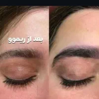 لیزر حذف تتو باپترو و ازاد|خدمات آرایشگری و زیبایی|بندر ماهشهر, |دیوار