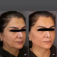 جشنواره تزریق فیلر،بوتاکس ،نخ،لاغری و هایفو|خدمات آرایشگری و زیبایی|تبریز, |دیوار