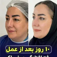 تخفیف ژل ،بوتاکس ،جوانساز،فیلر،ساکشن|خدمات آرایشگری و زیبایی|کرج, گلشهر|دیوار