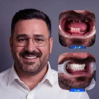 بیمه دندانپزشکی کامپوزیت زیبایی طلایی شو