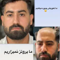 پروتزمو وکاشت موقت