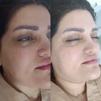فیشال تخصصیVIP با۱۴ مرحله پاکسازی و دستگاه پیشرفته|خدمات آرایشگری و زیبایی|گرگان, |دیوار