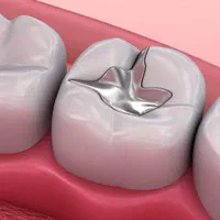 پسماند آمالگام دندانپزشکی و ضایعات آمالگام