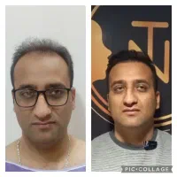 کاشت مو و ابرو با ضمانتنامه کتبی با ۸ ملیون تومان|خدمات آرایشگری و زیبایی|تهران, پاسداران|دیوار