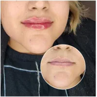 تخفیف ویژه بوتاکس،فیلر،مزو،لیزر موهای زائد کندلا|خدمات آرایشگری و زیبایی|کرج, فاز ۲ مهرشهر|دیوار