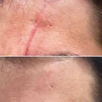 لیزر جای جوش،بخیه و لک