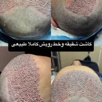 کاشت مو و ابرو طبیعی|خدمات آرایشگری و زیبایی|تهران, میرداماد|دیوار