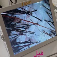 درمان پوستِ سر (اسکراب اسکالپ) ویژه بانوان