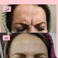 مدل برای فقط بوتاکس زیر نظر پزشک