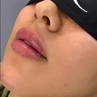 تخفیف۳۵ درصد  بوتاکس و فیلر فرصت محدود