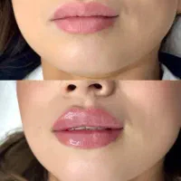 جشنواره تخفیفات ژل بوتاکس دکترکاظمی|خدمات آرایشگری و زیبایی|مشهد, کوثر|دیوار