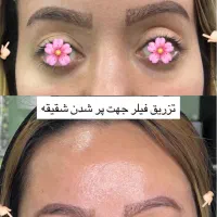 آف تزریق ژل و بوتاکس آ