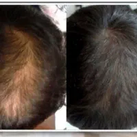 خداحافظی با کلاه گیس رویش مو با ضمانت بازگشت وجه