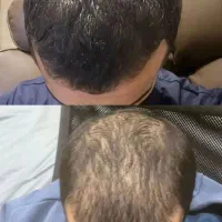 تونیک اکسونیک ضد ریش مو و رشد مجدد مو پر پشت مو