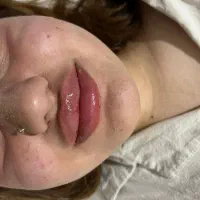 فیلر(ژل)و بوتاکس