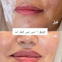 تخفیفات یلدایی فیلر ، ژل ، بوتاکس ، فیلر بادی|خدمات آرایشگری و زیبایی|ارومیه, |دیوار