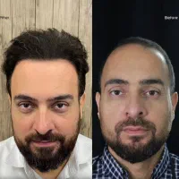 اقتصادی ترین کلینیک کاشت مو و ابرو در تهران/ اقساط|خدمات آرایشگری و زیبایی|تهران, سعادت‌آباد|دیوار