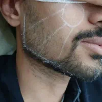 آموزش و تزریق ژل بوتاکس مزو به قیمت باور نکردنی